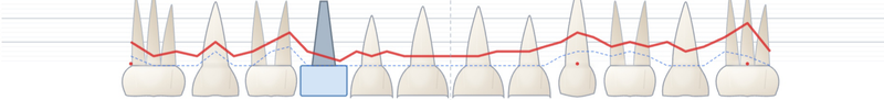 Periodontal chart teeth with pocket depth indicators
